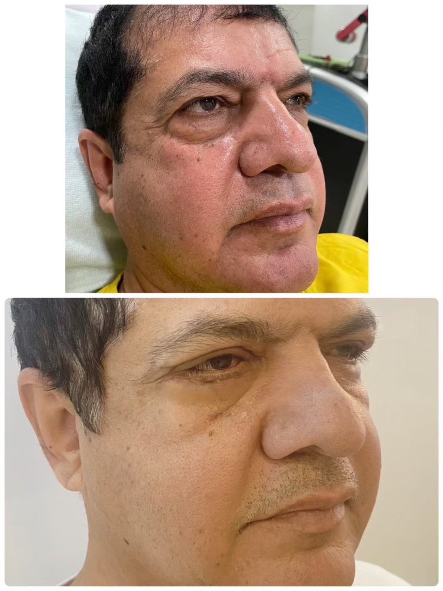 Before and after stem cell rejuvenation therapy results at ID Clinic Bangkok for anti-aging