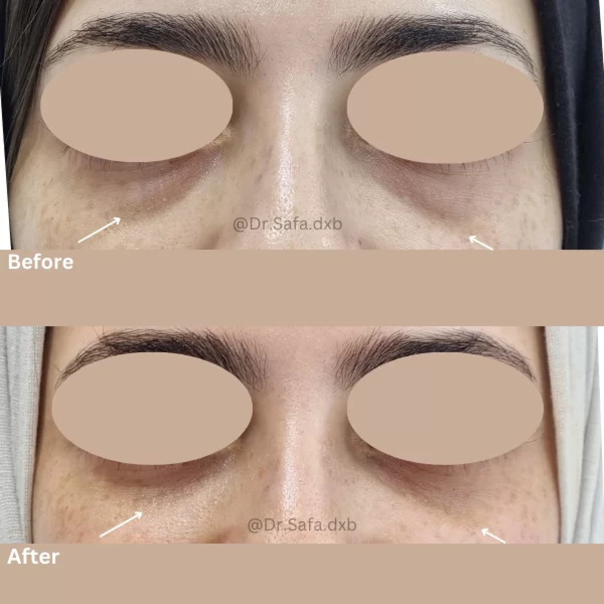 Before and after fillers injection for under-eye dark circles, visible rejuvenation result