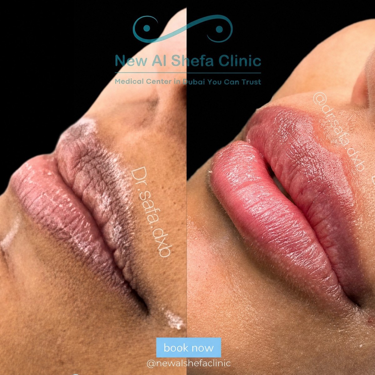 Before and after lip fillers injection result at New Al Shefa Clinic, enhanced lip volume