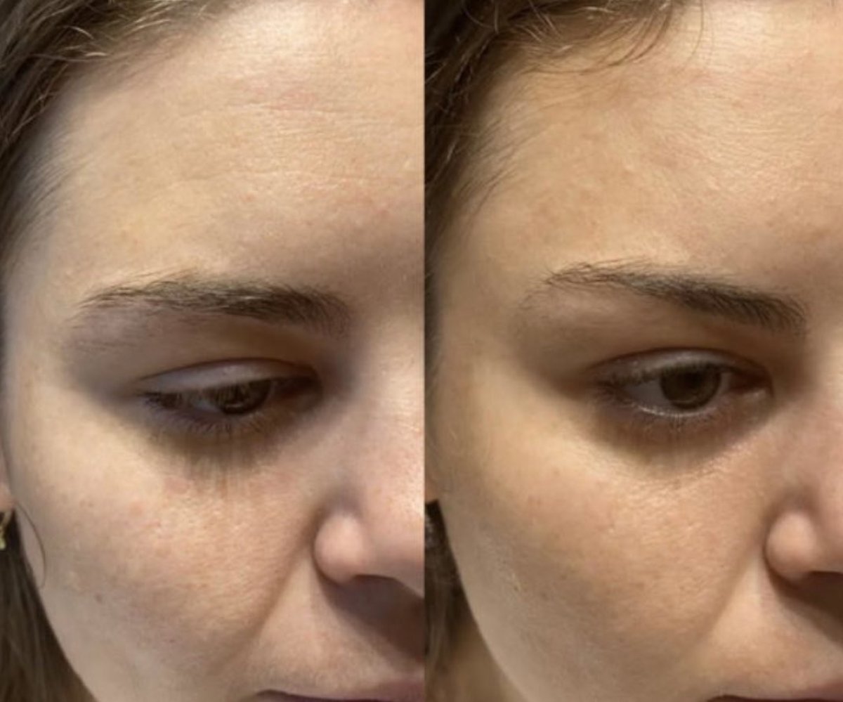 Before and after anti-wrinkle injectables result, smoother forehead and eye area skin