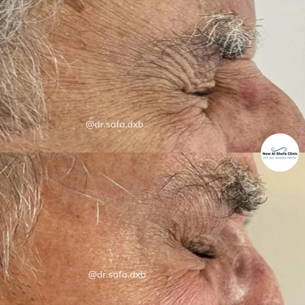 Blepharoplasty before and after results at New Al Shefa Clinic, reduced eyelid wrinkles
