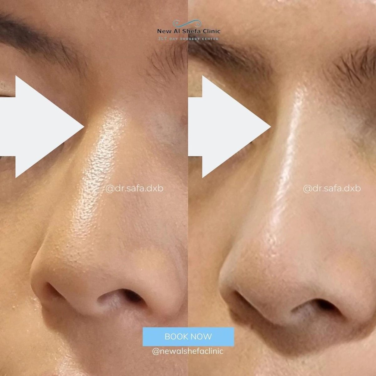 Before and after non-surgical nose correction result at New Al Shefa Clinic, nose reshaping