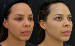 Fotos vor und nach Rhinoplastik (Nasenkorrektur) durch Dr. Imelda Peraza Gregor 