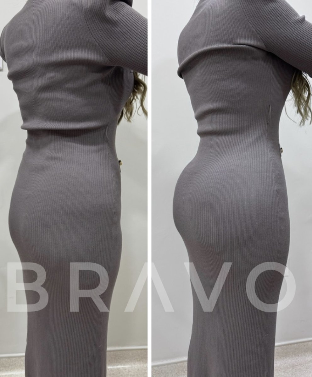 Before and after Brazilian Butt Lift results at Bravo clinic – enhanced buttock contour