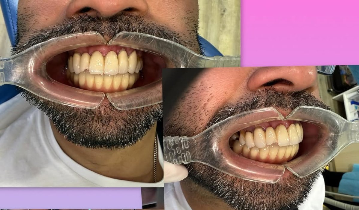 Résultat avant/après implants dentaires All-on-6 en un jour, sourire et alignement améliorés