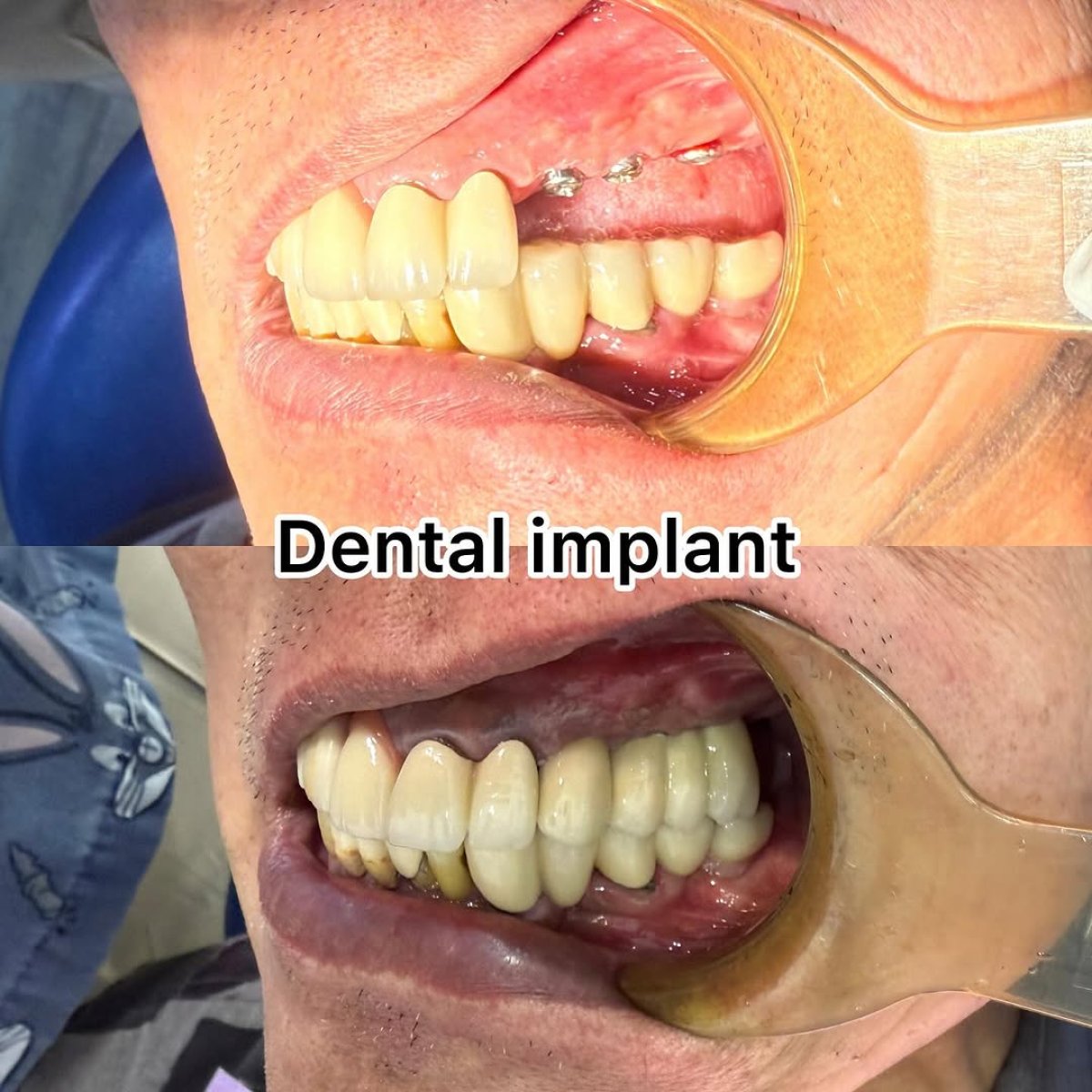 Resultados antes y después de puente dental sobre implantes, mejora de sonrisa y masticación
