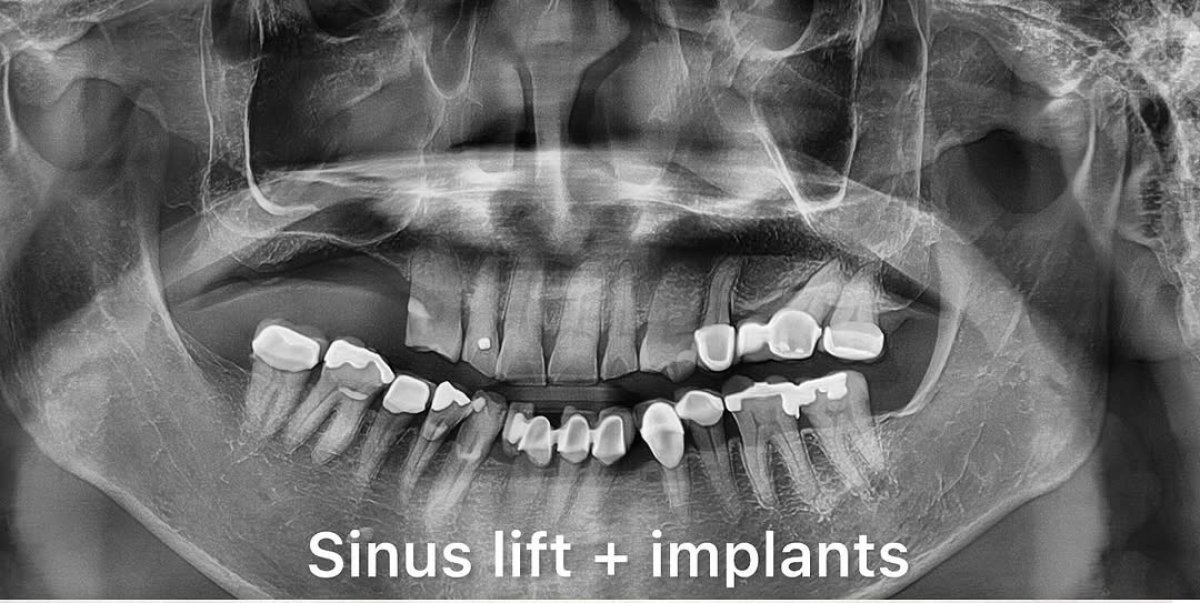 Dental X-ray showing lateral window sinus lift and dental implants result