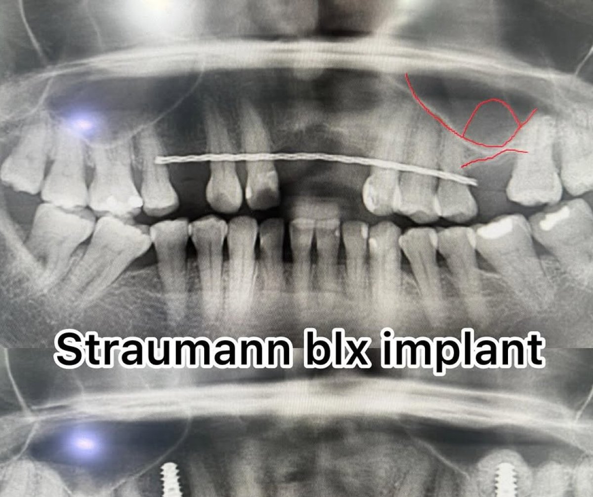 Before and after Straumann BLX dental implant x-ray results, visible implant placement