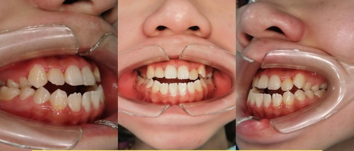 Результаты до и после Invisalign – выравнивание зубов и более ровная улыбка