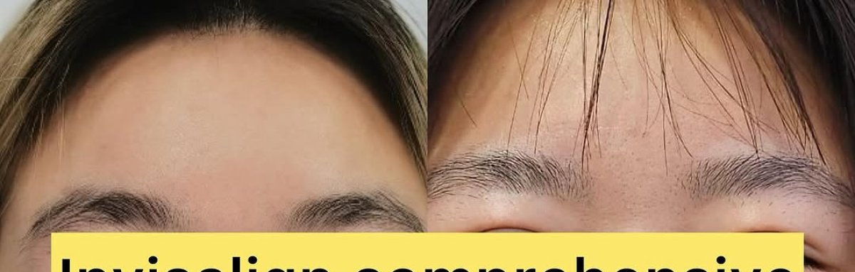 Resultados de antes y después de Invisalign – mejora visible en la alineación dental en la clínica