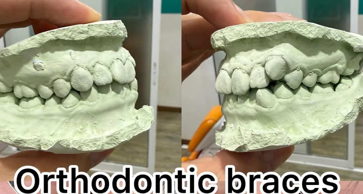 Resultados antes y después de brackets: alineación dental mejorada con ortodoncia