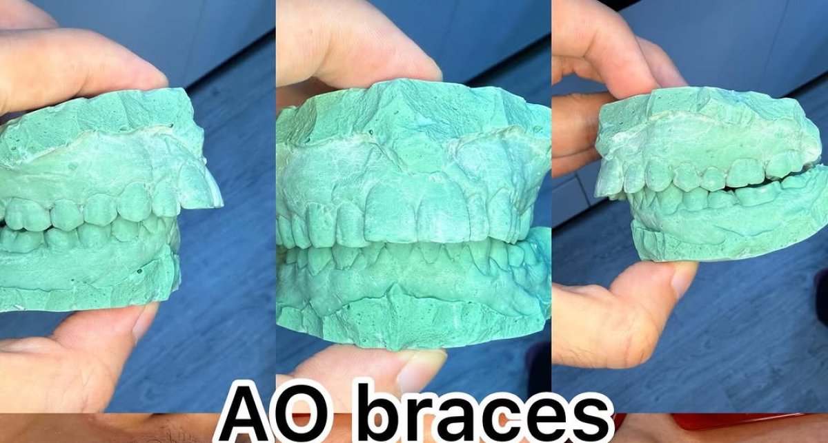 Resultados antes y después de brackets AO: alineación dental y corrección de mordida