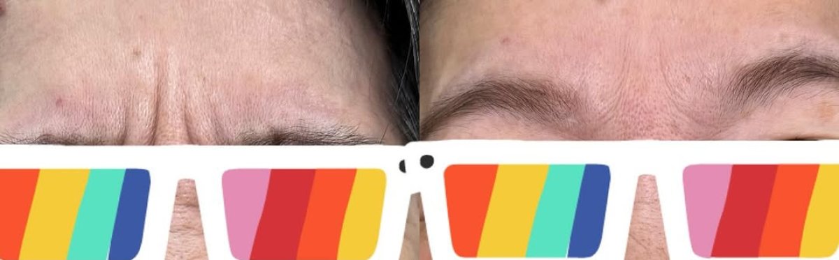 Resultados antes y después de botox para reducción de arrugas en la frente, piel más lisa