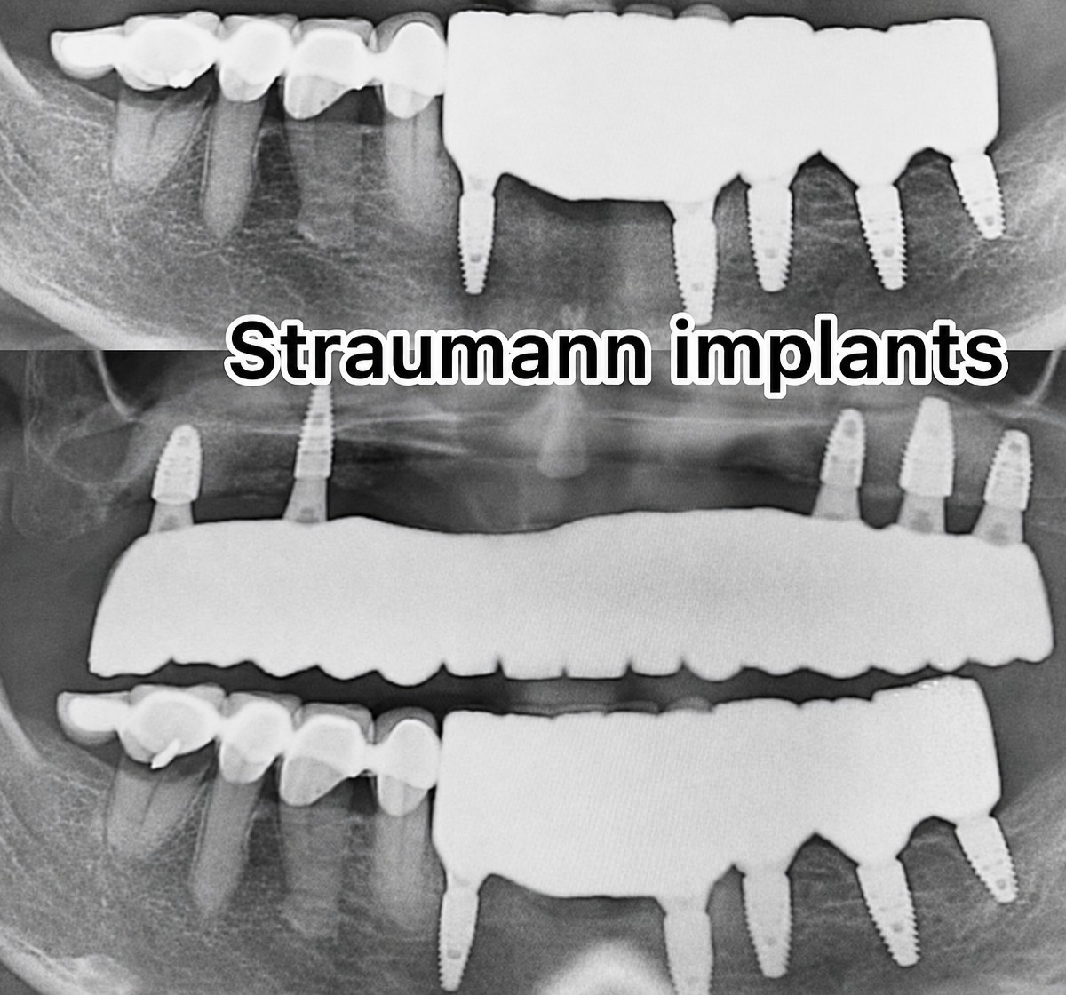 Efekty implantów Straumann – panoramiczne RTG pełnej rekonstrukcji łuku