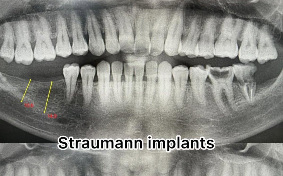 RTG zębów z planowanymi wynikami implantów Straumann w dolnej szczęce
