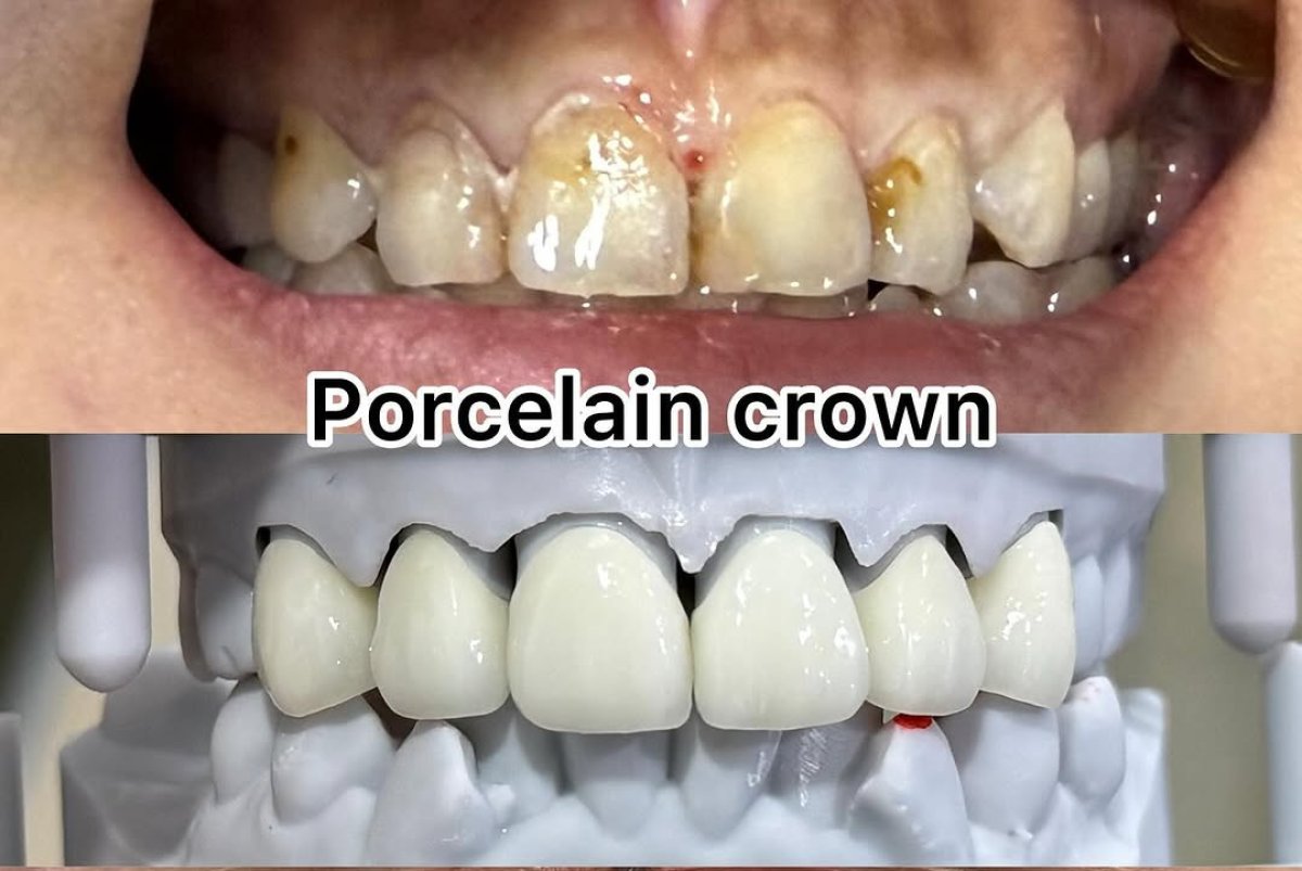 Before and after porcelain dental crown installation results – improved front teeth appearance