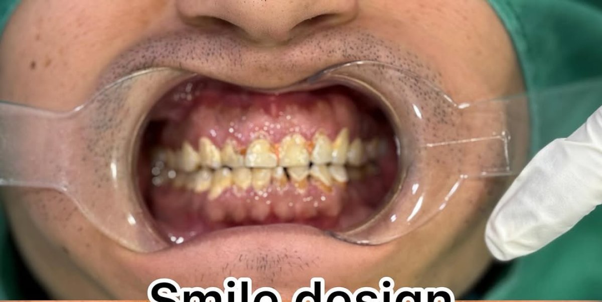 Before dental crown installation at clinic – visible tooth discoloration and misalignment