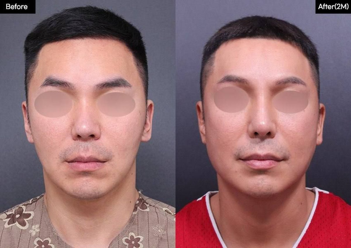 Before and after rhinoplasty results at VG Plastic Surgery, improved nose shape in male patient