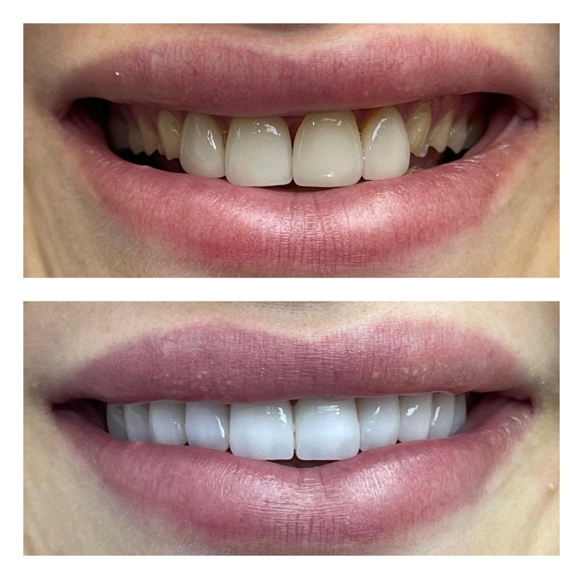 Resultados antes y después de Hollywood Smile en Nifa Dent International: dientes blancos y parejos