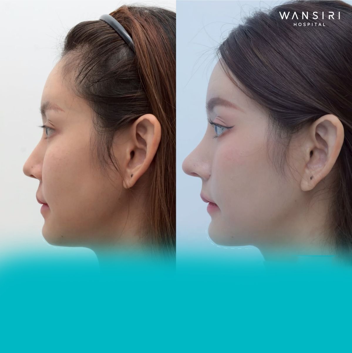 Результаты ринопластики до и после в Wansiri Hospital, естественная форма носа