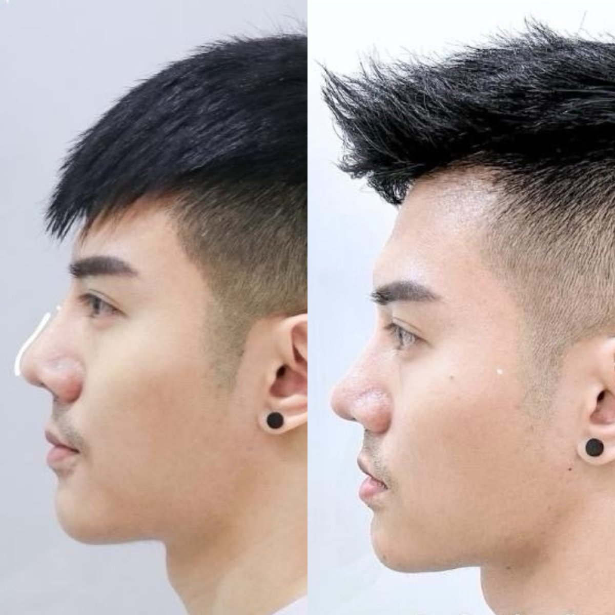 Résultat avant/après rhinoplastie à la Somchai Clinic, forme du nez améliorée chez l’homme