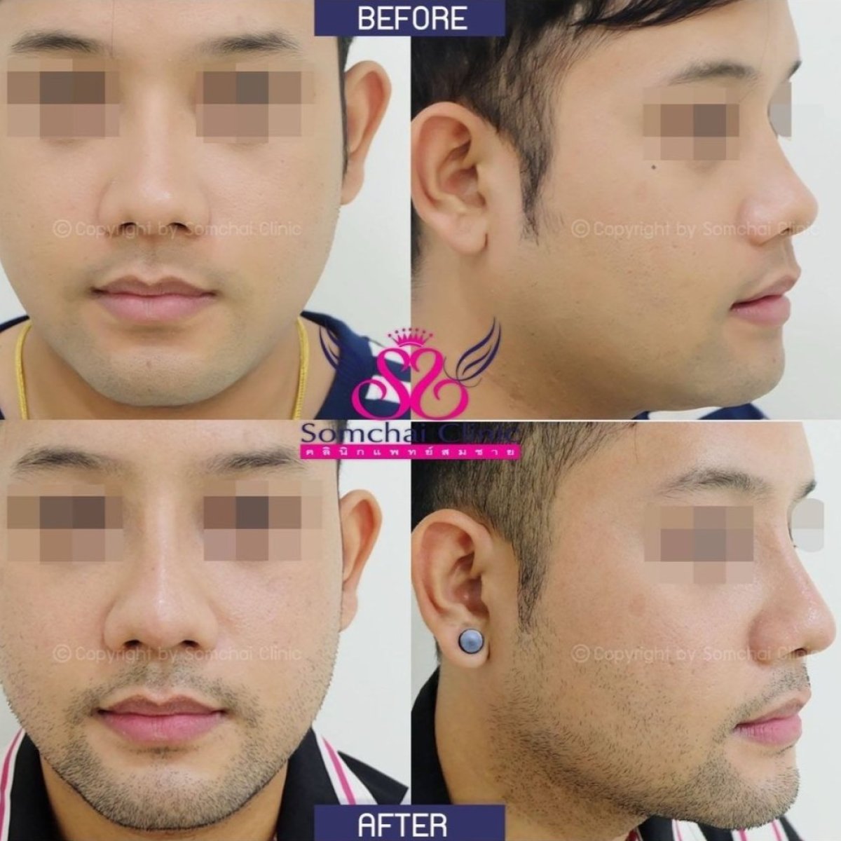 Resultados de rinoplastia antes y después en Somchai Clinic, mejora de forma y perfil nasal