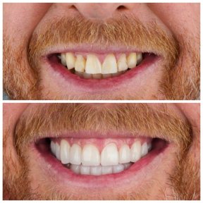 Smile Makeover with 12 Zirconia Crowns — 4-Star Hotel & VIP Transfer - photo 4
