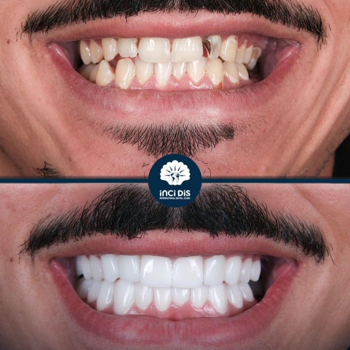 Résultats avant et après Hollywood Smile chez Inci Dis International, transformation par facettes