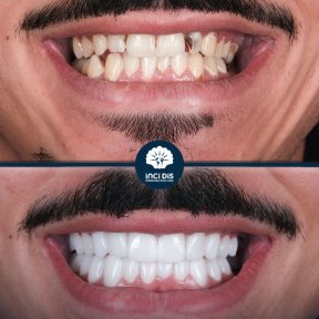 Hollywood Smile with 28 Monolithic Zirconia Crowns - photo 4