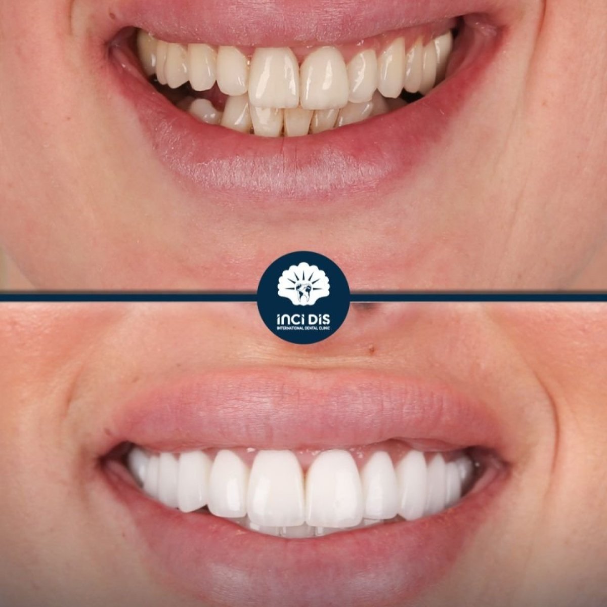 Результаты до и после Hollywood Smile в Inci Dis International, трансформация винирами
