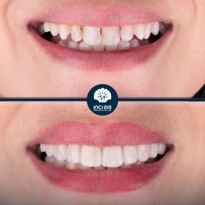 Hollywood Smile with 28 Monolithic Zirconia Crowns - photo 5