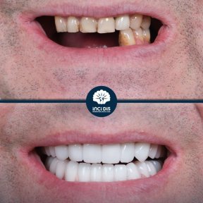 Single Dental Implant with Medigma Implant - photo 4