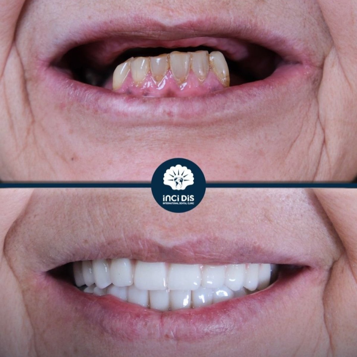 Before and after dental implant results at Inci Dis International, restored smile transformation