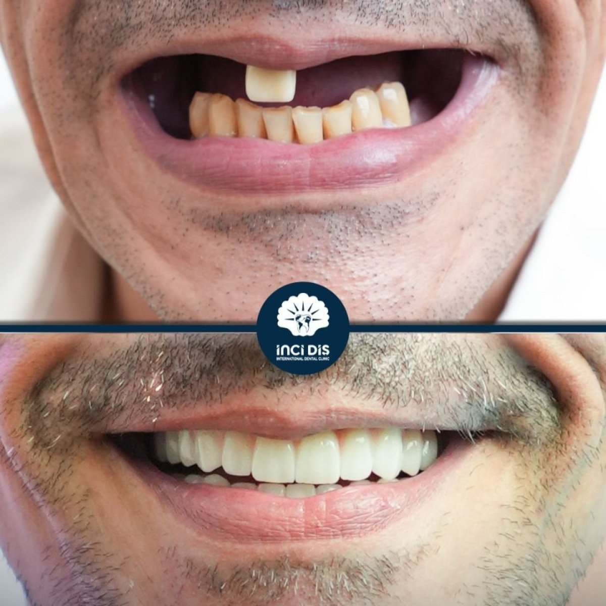 Before and after dental implant results at Inci Dis International – restored smile transformation