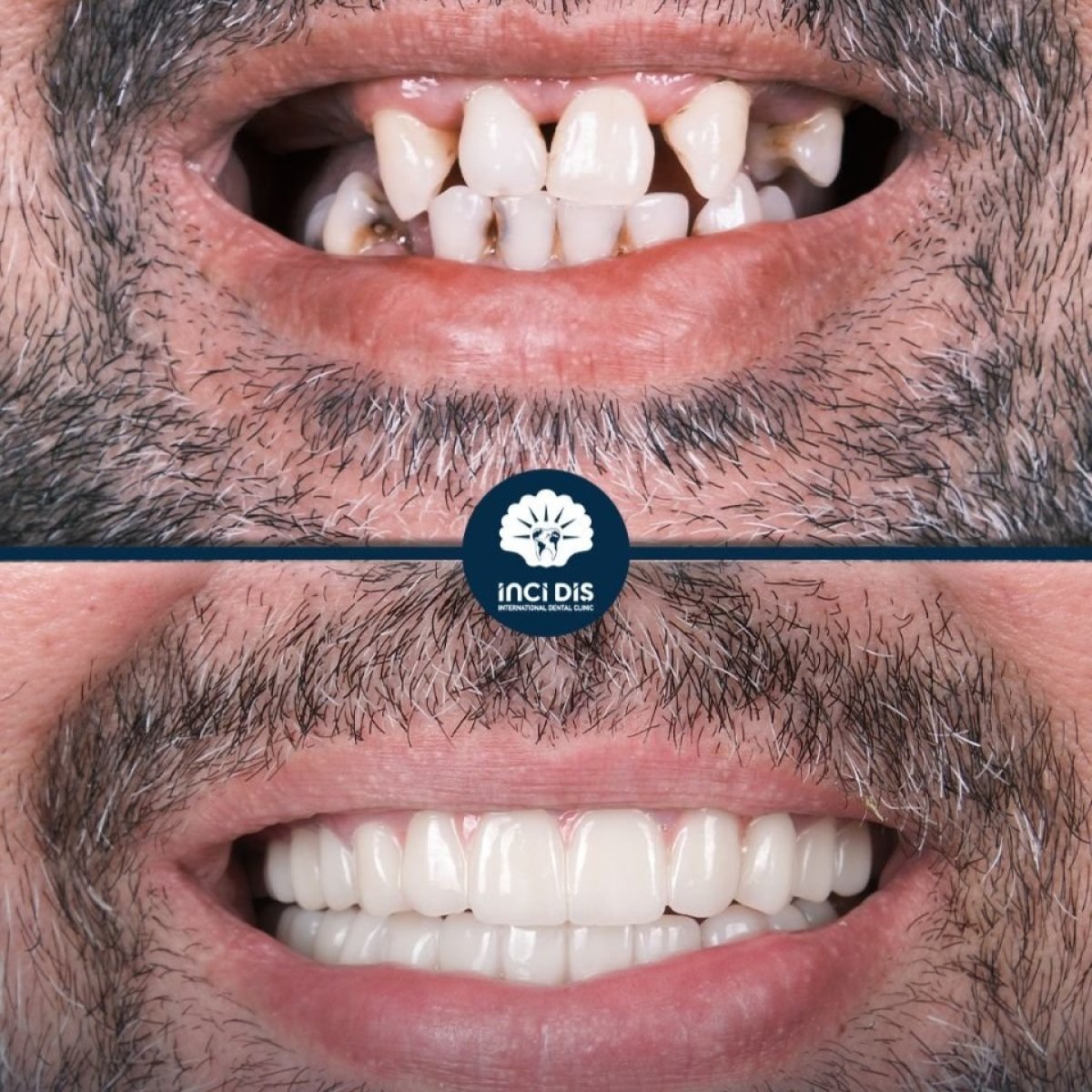 Before and after dental implant results at Inci Dis International, restored smile transformation