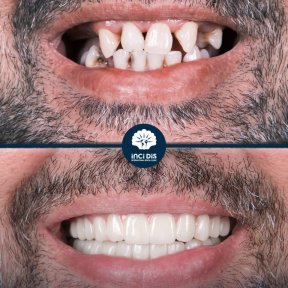 Single Dental Implant with Medigma Implant - photo 5