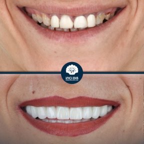 Full Set of 28 Zirconia Crowns, Straumann Swiss - photo 4