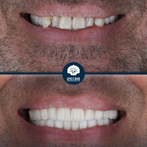 Full Set of 28 Zirconia Crowns, Straumann Swiss - photo 5
