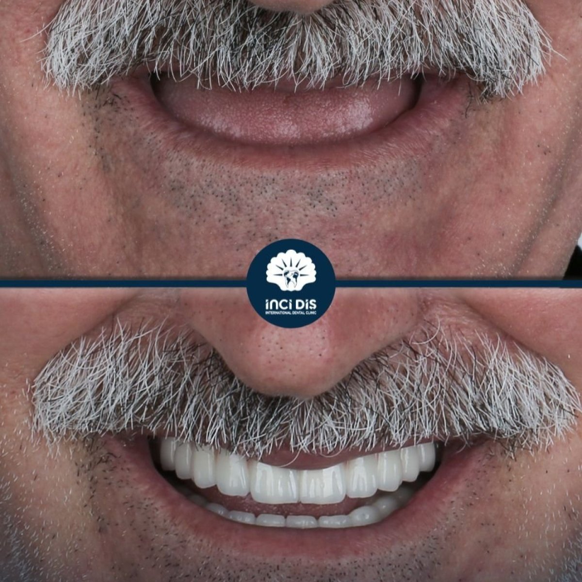 Resultado antes y después de implantes All-on-4 en Inci Dis International, sonrisa restaurada