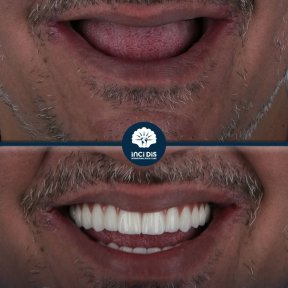 All-on-4 Dental Implants with Medigma Implants - photo 4