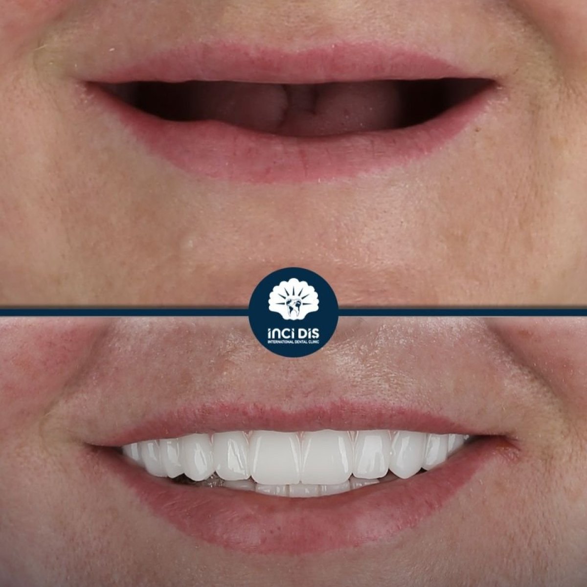 Resultado antes y después de implantes All-on-4 en Inci Dis International, sonrisa restaurada