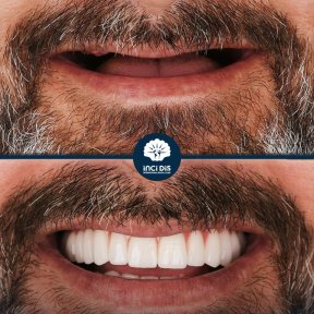 All-on-6 Dental Implants with Straumann Implants - photo 4