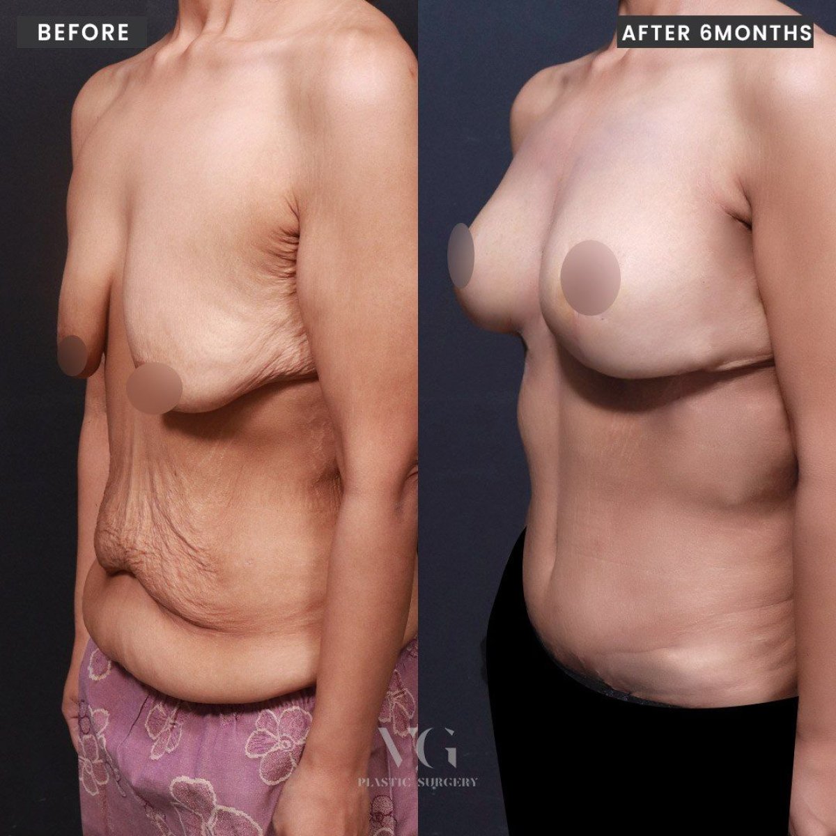 نتائج شد البطن ورفع الثدي في VG Plastic Surgery بعد 6 أشهر من العملية
