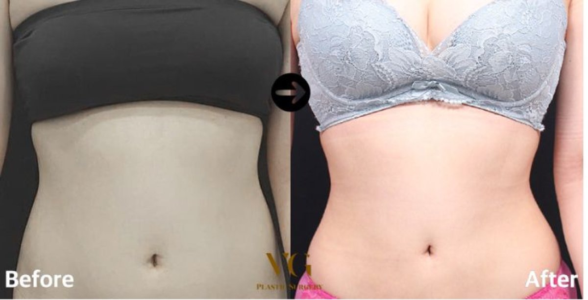 نتائج شفط الدهون 360 قبل وبعد في VG Plastic Surgery – تحسين محيط الخصر