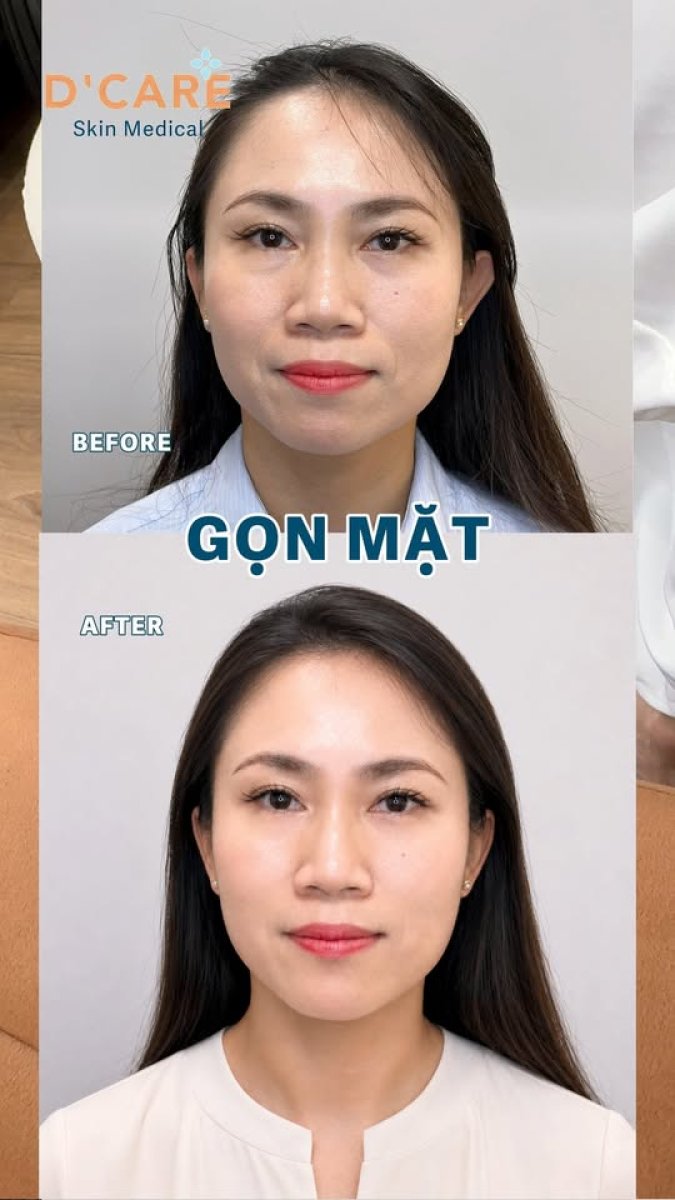 Before and after Thermage face slimming results at D'Care Skin Medical Clinic