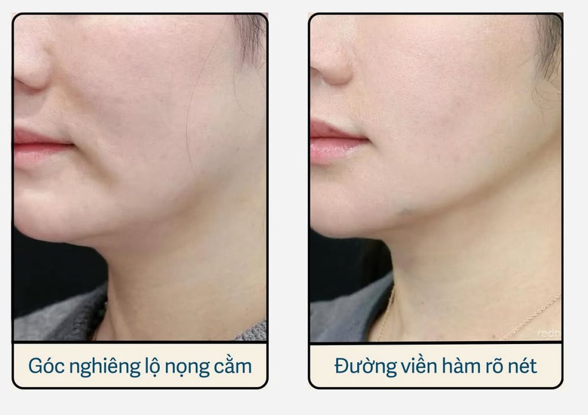 Before and after Thermage results – improved jawline contour and reduced double chin