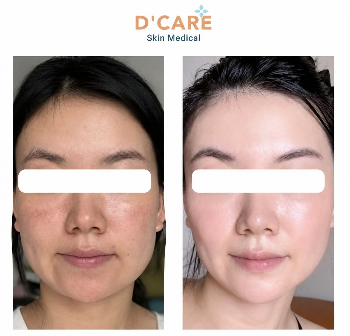 Microneedling before and after results at D'Care Skin Medical – improved facial skin texture