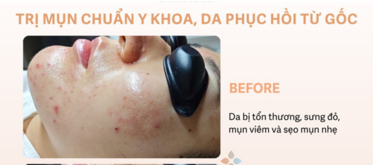 Before acne scar treatment result, inflamed skin with redness and mild acne scars visible