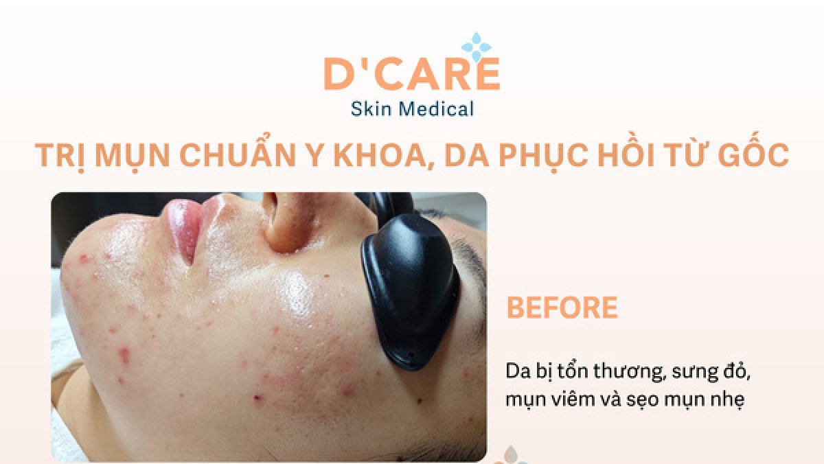 Before acne scar treatment at D'Care Skin Medical, visible inflamed acne and mild scarring
