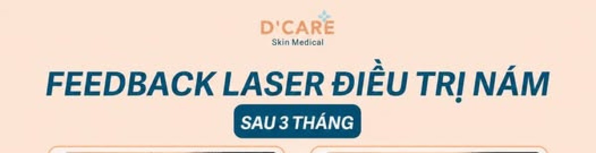 Результаты до и после лазерного лечения мелазмы в D'Care Skin Medical через 3 месяца